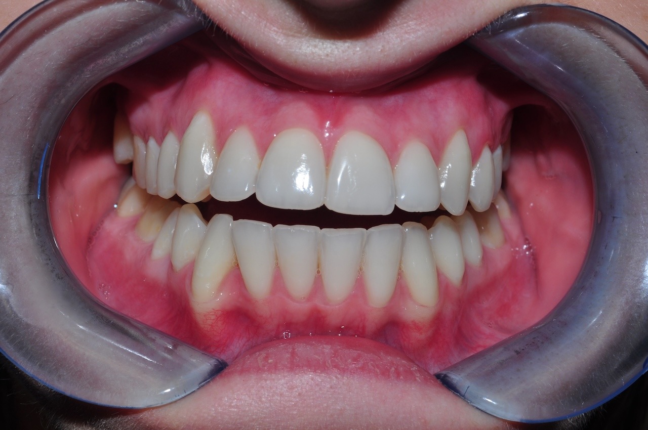teeth whitening
